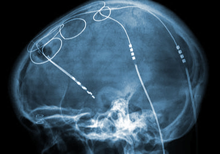 Röntgenaufnahme eines Schädels mit Sonden